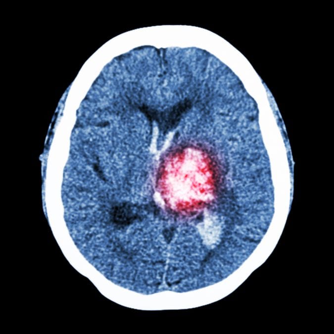 Hemmorhage on MRI scan