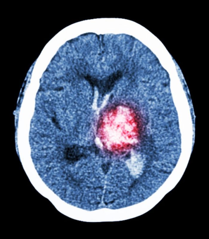 Can Cannabinoids Reduce Damage From Brain Hemorrhage?