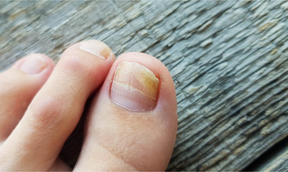 fungus infection represented by toe nail infection