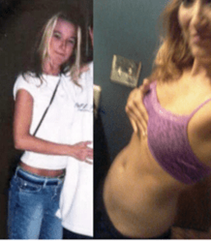 Those Years of Pain and Suffering With Anorexia - Until Cannabis