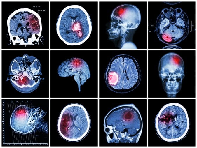 MRI scans showing red area of brain injury