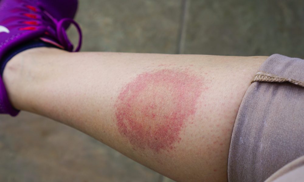 cannabis oil and Lyme disease represented by a bull's eye rash on a woman's lower leg. 