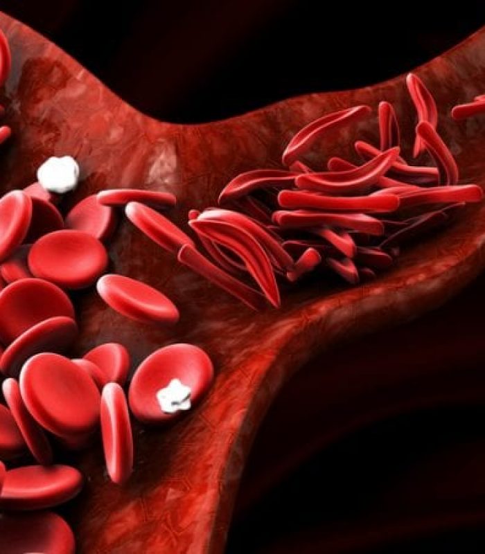 Will Cannabis Help Sickle Cell Anemia Pain and Inflammation?