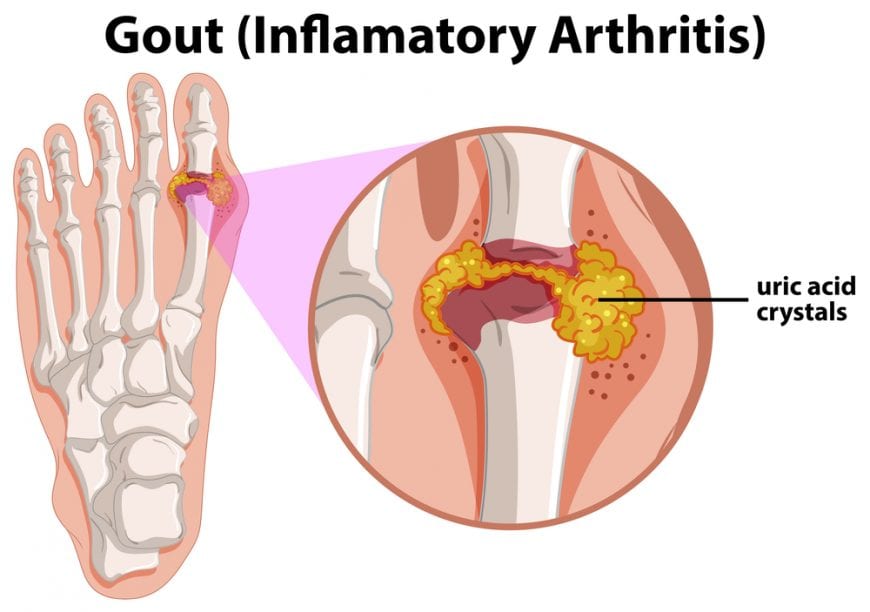 Gout animation showing crystal deposits in joint