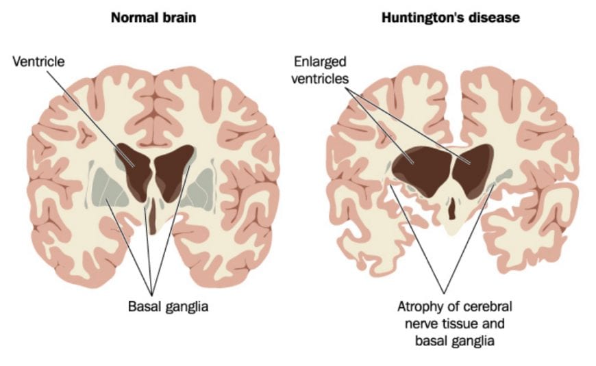 Normal Versus Huntingtons diagram, showing how cbg oil would make the HD brain more normal