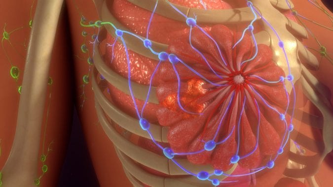 Breast Cancer showing metastatis