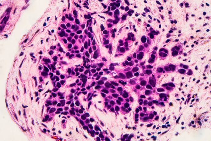 Beast Cancer Micrograph