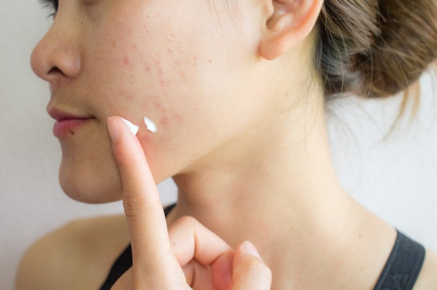 Young woman with acne putting cream on her face