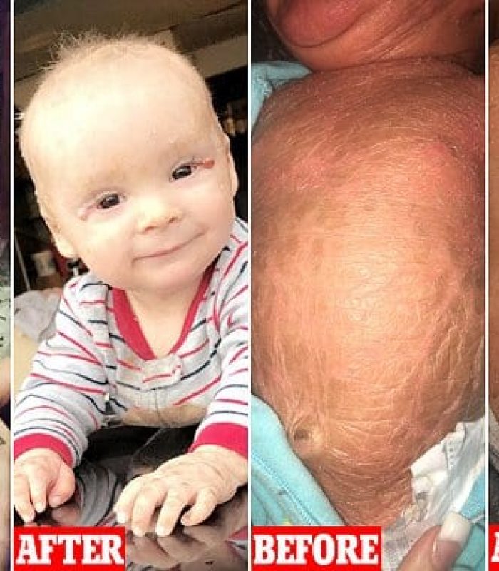 Parents Report Cannabis Salve Helped Baby With Horrific Skin Condition