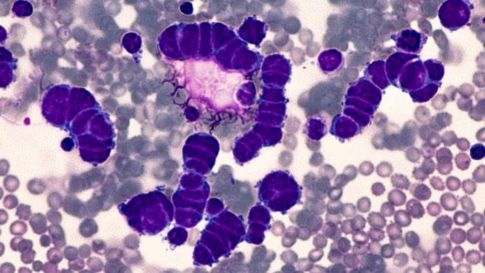 microscopic view of lung cancer cells