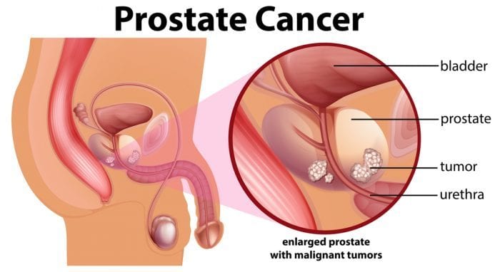 animation showing prostate cancer vs healthy prostate