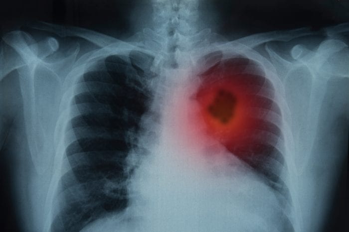 xray showing lung cancer tumor