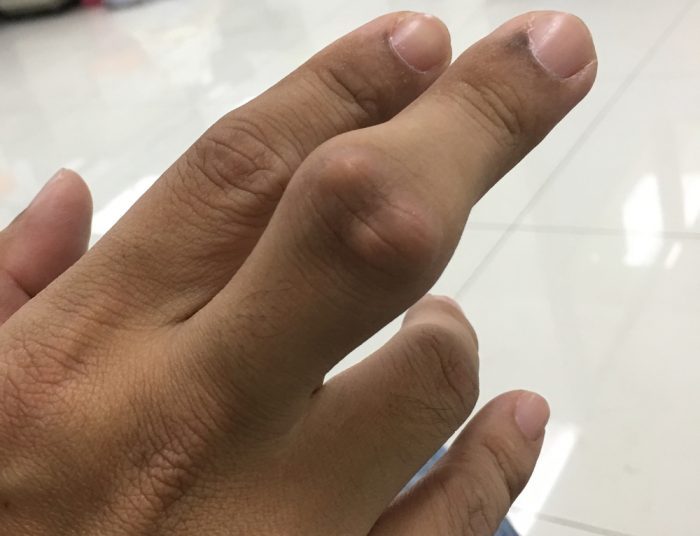 gout in a finger may be treated with friedelin