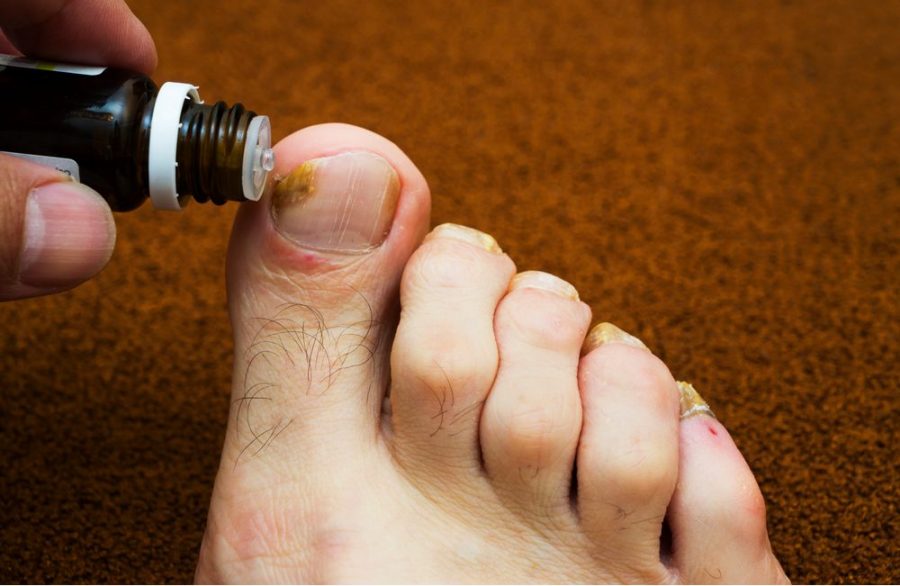 medical toenail fungus infection