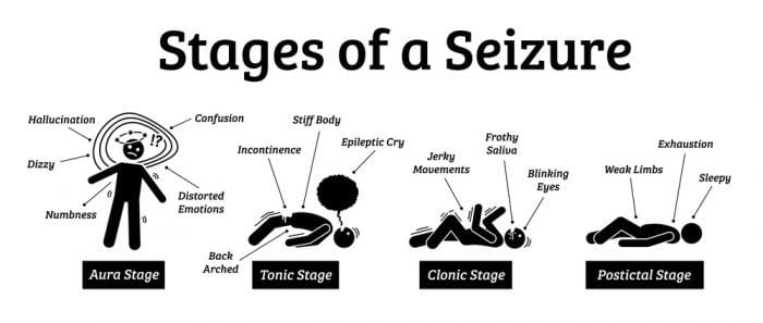 controlling epilepsy PSA stages of seizure