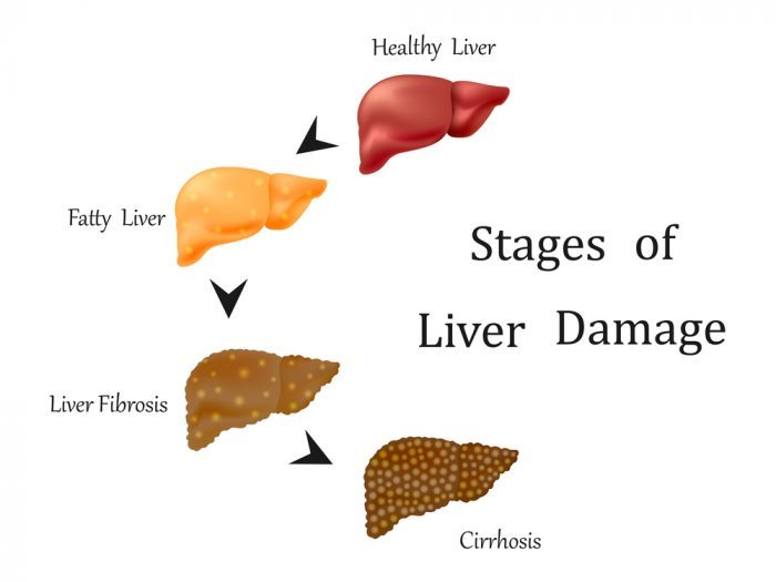 liver, liver damage, CBD, cannabinoids, cannabis, medical cannabis, recreational cannabis, liver health, alcohol, alcohol damage