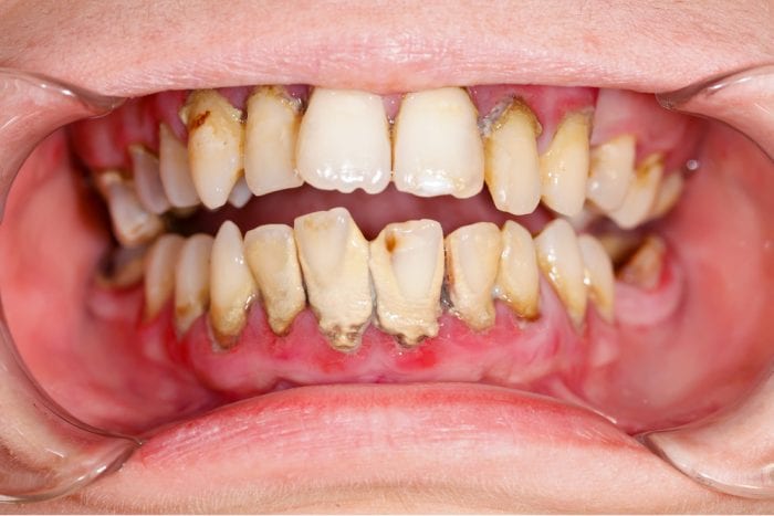 cannabis, medical cannabis, gingivitis, cannabis and teeth, oral health, oral hygiene, dental hygiene, dental care