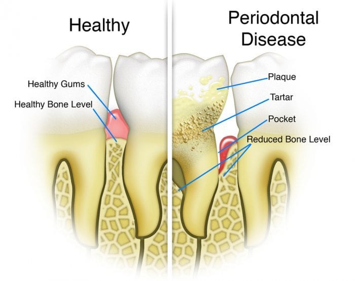 tooth loss, periodontitis, gum disease, periodontal health, dental health, oral hygiene, cannabis, smoking cannabis, health risks