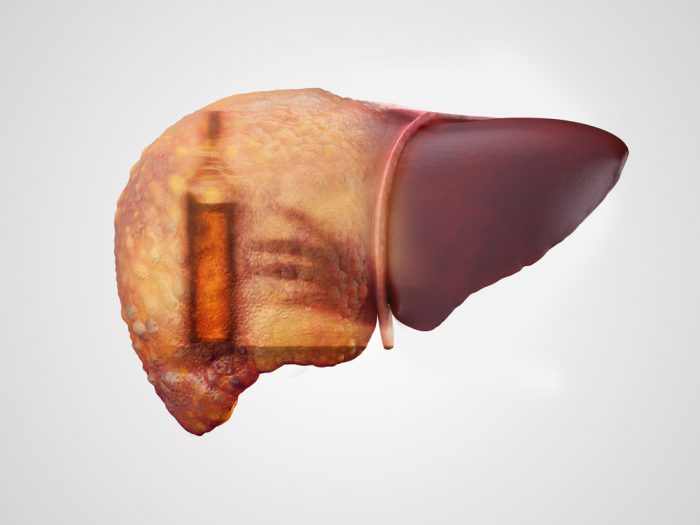 recovery from alcohol abuse showing in damage liver