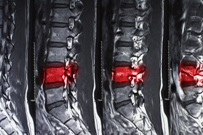 spinal cord injury in xray
