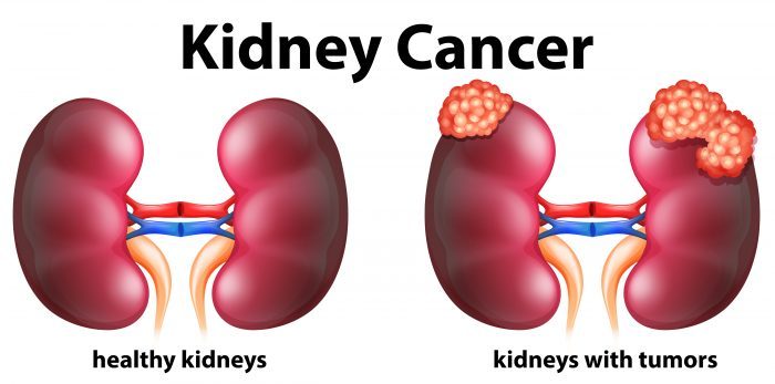 kidney canacer graphic