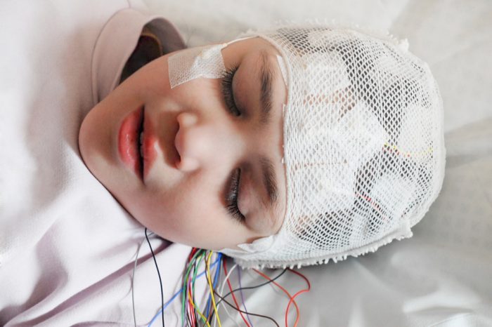 how much cbd for epilepsy represented by young woman hooked up to brain wave monitor