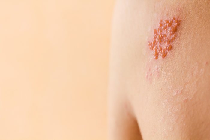 treating shingles naturally could be what this person with visible shingles needs