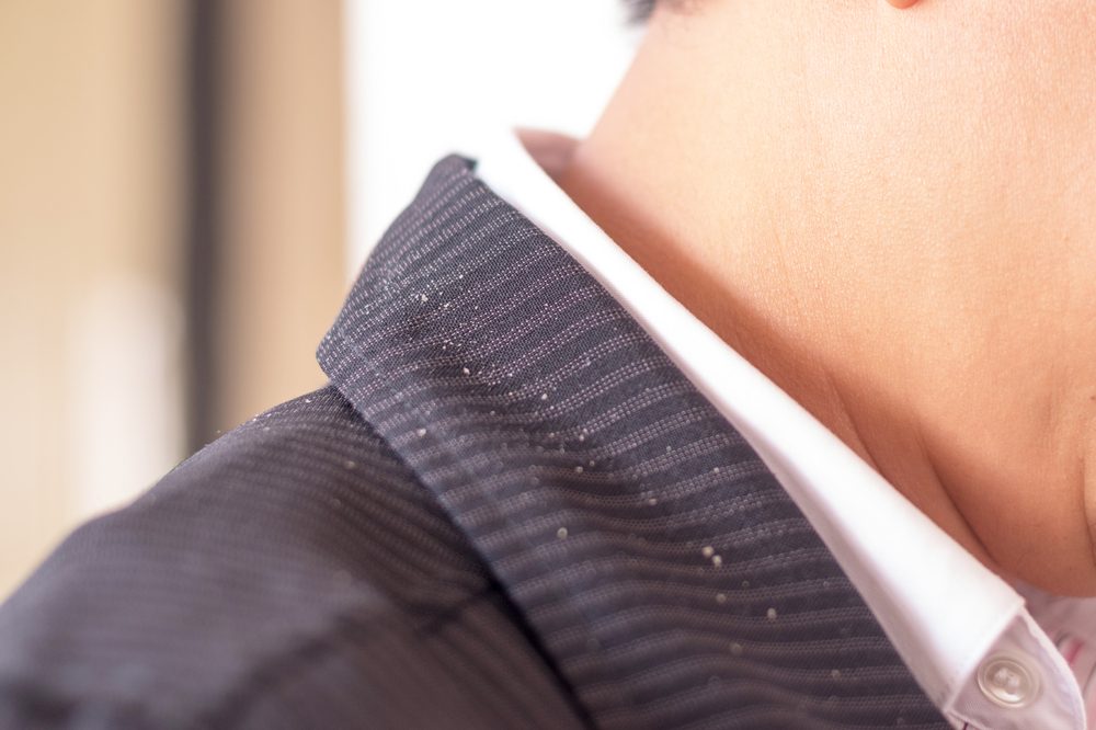 diy dandruff treatment represented by flakes on white man's shoulders